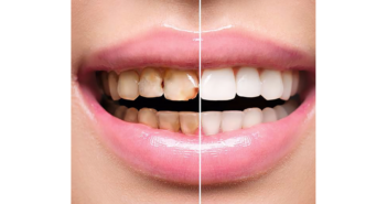 Top-Rated Family Dentist In Buford Offers Regular Teeth Cleaning Services & Oral Exams