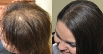 Female Hair Loss Causes & Treatments: Can It Actually Be Reversed?